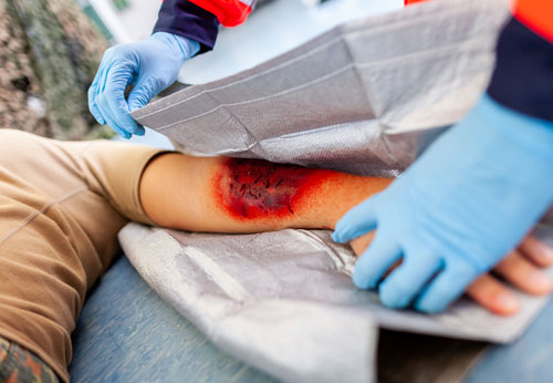 Burn Injury Lawyer, Providence, RI