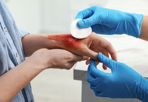 Burn Injury Lawyer, Providence, RI